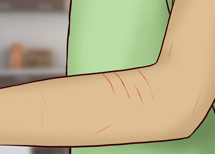 cat scratch antibiotic